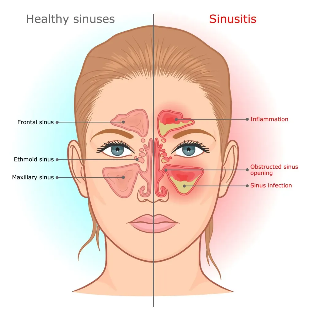 Allergic Fungal Sinusitis